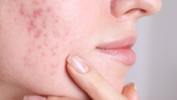 The Gut–Skin Axis: Could Your Gut Be Driving Psoriasis, Eczema or Acne?